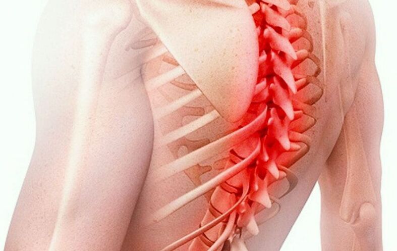 остеохондроз грудного відділу хребта